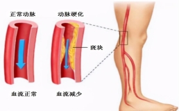 什么是下肢动脉硬化闭塞症？