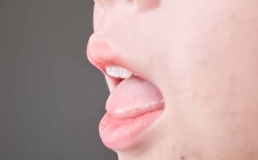 经常咬到舌头真的是馋肉吗？错！可能是疾病信号！