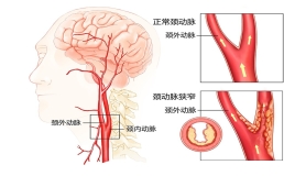 颈动脉狭窄与脑梗或只一步之遥