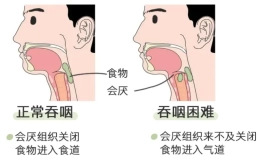 吞咽障碍的康复