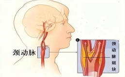 颈动脉斑块堵塞血管，这几类人要重视