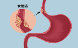 吃饭经常出现这个表现，很可能是癌症的信号！