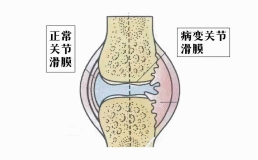 什么是滑囊炎？滑囊炎是怎样发生的？