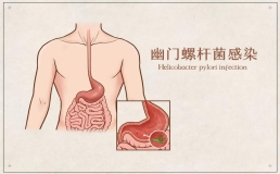 全家感染幽门螺杆菌！多和餐桌上4个陋习有关！