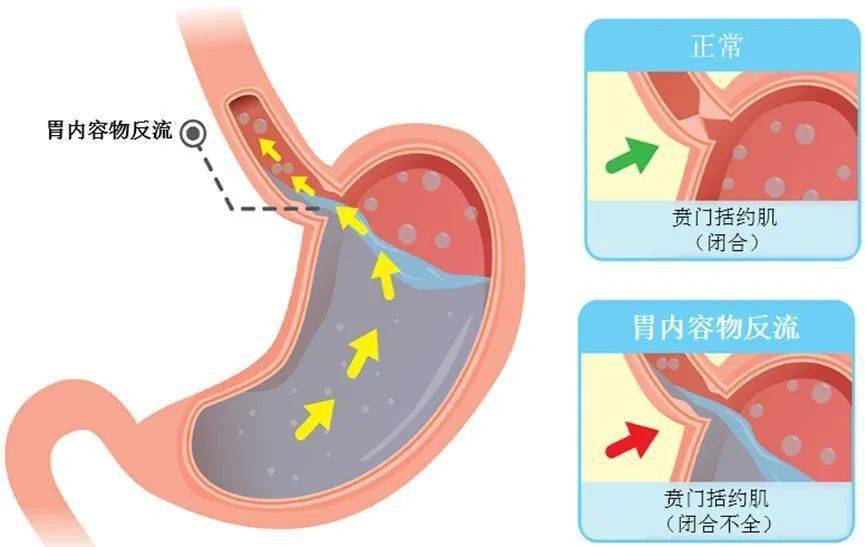 经常胃痛的人，还在喝这几类饮料吗？