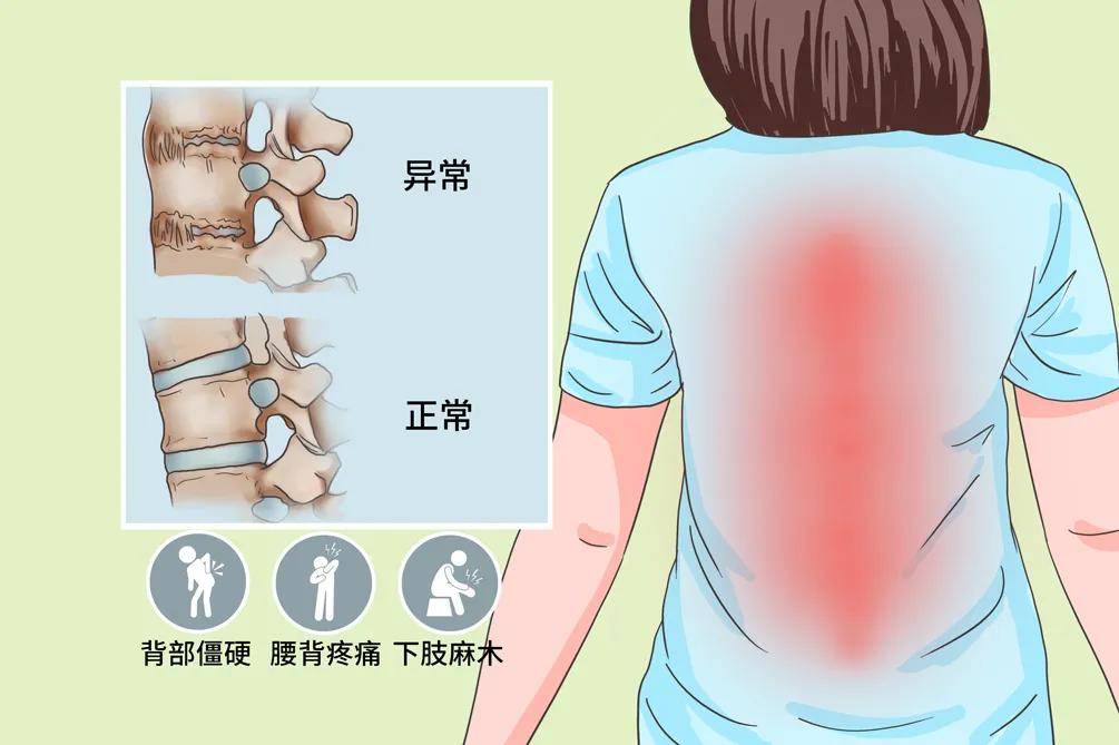 强直性脊椎炎的康复