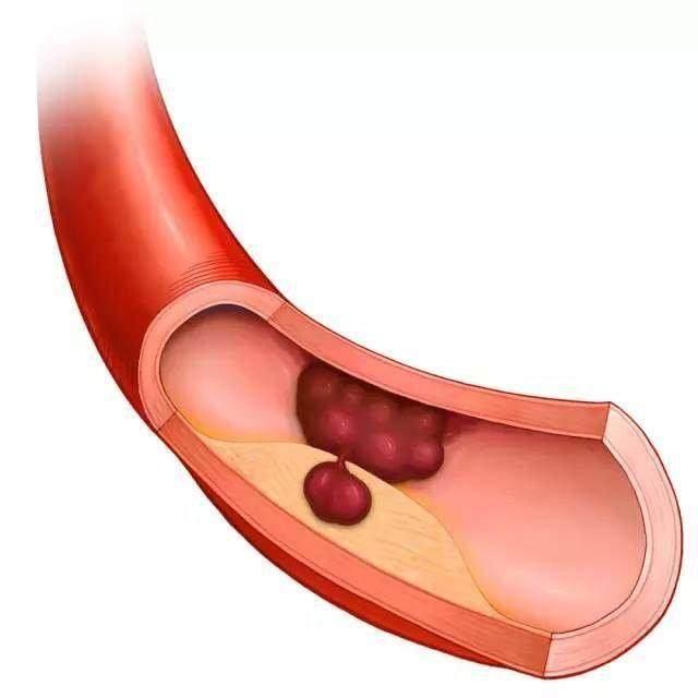 血栓出现都是不声不响的？血栓形成有哪些信号？