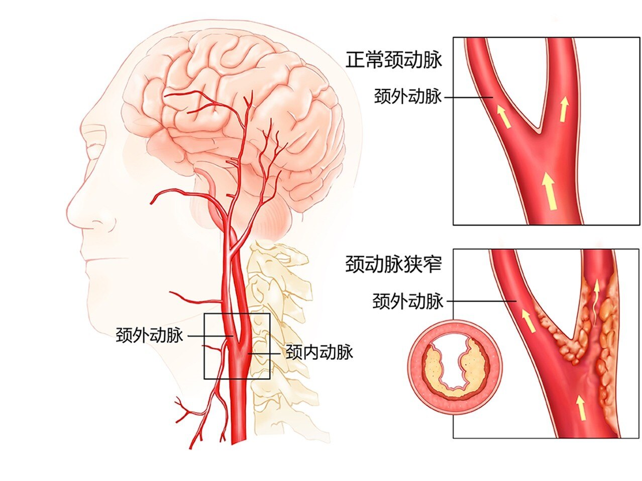 颈动脉狭窄与脑梗或只一步之遥