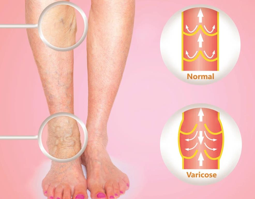 腿疼、腿肿……有这几种症状可能血管被堵了！3个方法有效预防