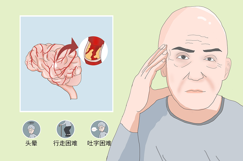 控制脑血管病发生的重点