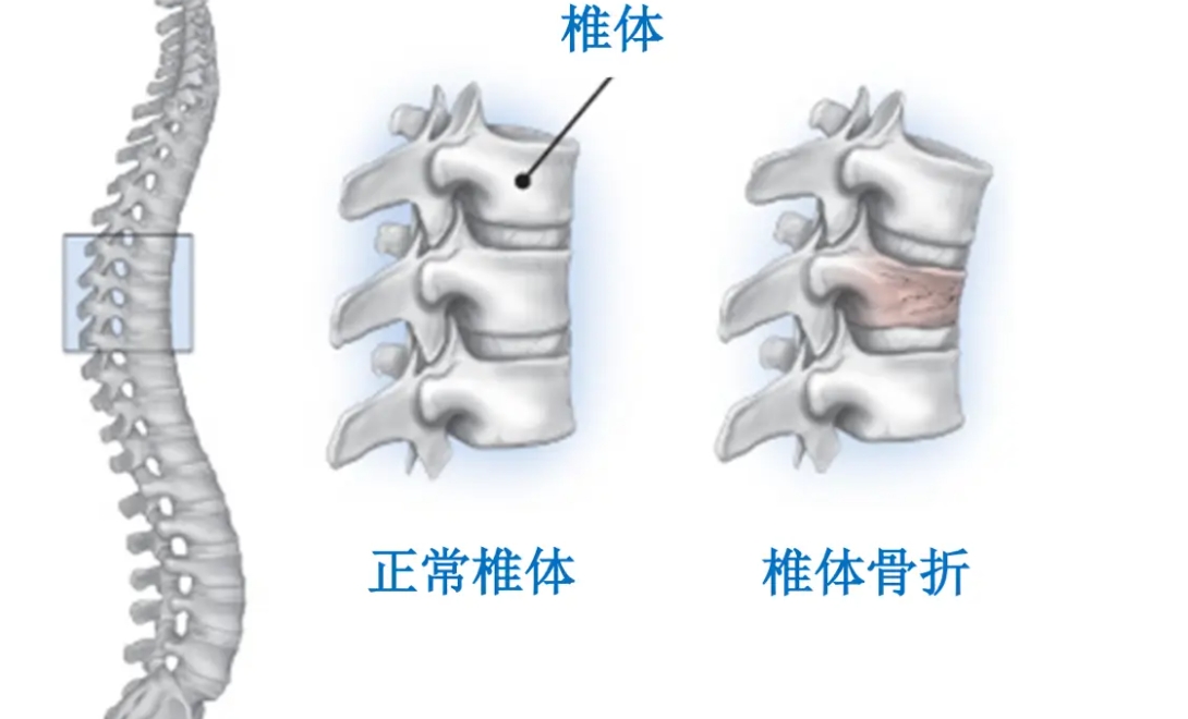 打个喷嚏就骨折？这是怎么回事？